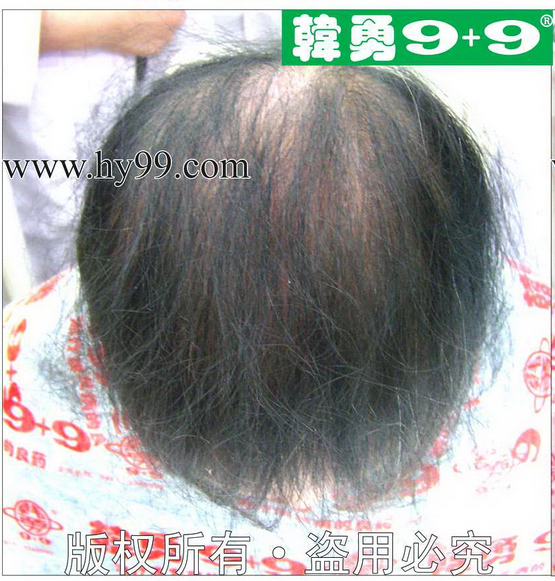 脂溢性脱发