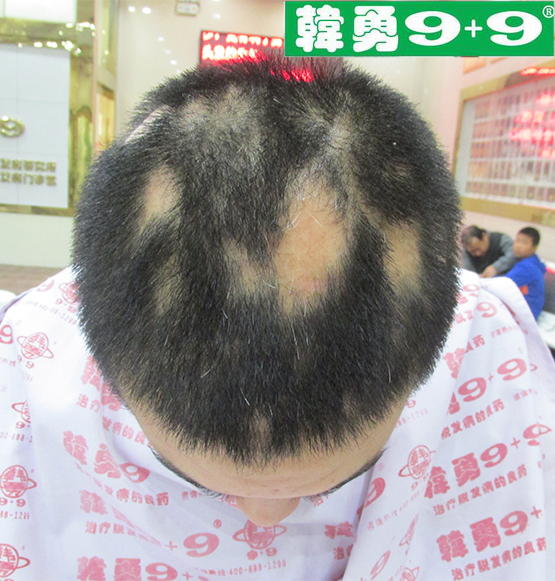 斑秃